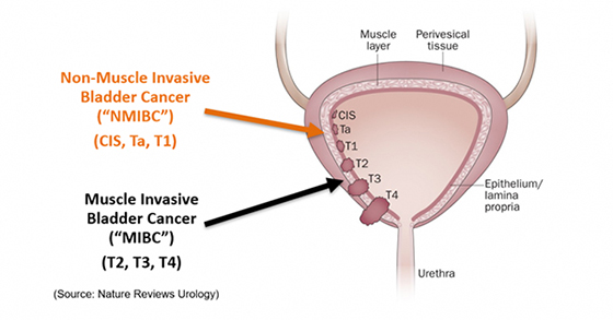 Illustration of Muscle-Invasive Bladder Cancer and Non-Muscle-Invasive Bladder Cancer